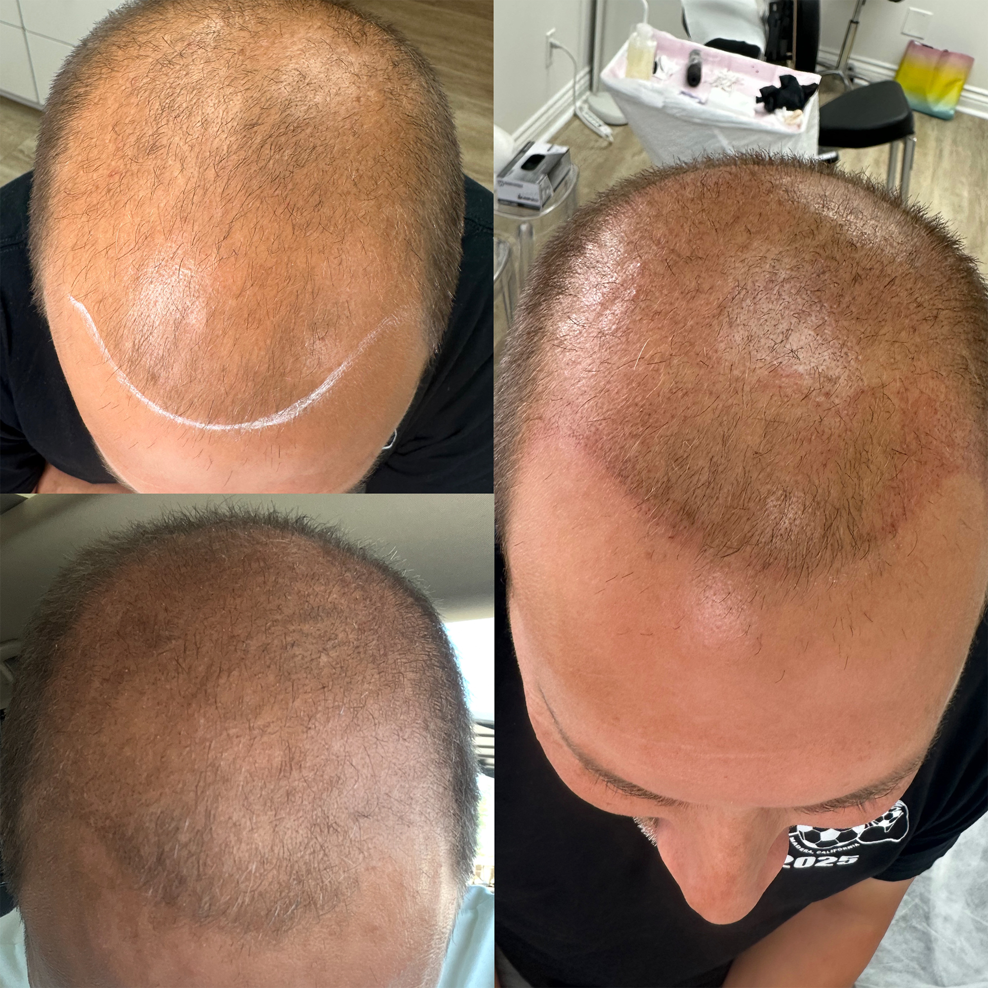 Jamie Harlan Permanent Makeup Studio Fresno CA Scalp Micro Pigmentation 1